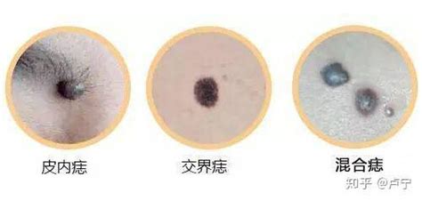 痣種類|痣形成的原因？痣長毛、痣變多變大是痣病變？5招判。